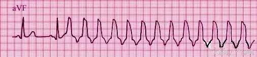 自己怎么看懂心电图（这样教你看心电图）(15)