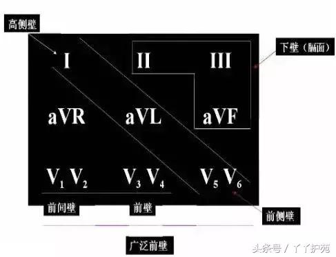 自己怎么看懂心电图（这样教你看心电图）(19)