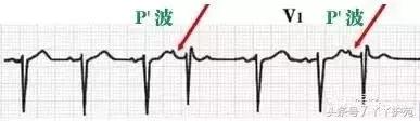 自己怎么看懂心电图（这样教你看心电图）(11)