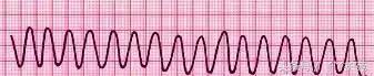 自己怎么看懂心电图（这样教你看心电图）(16)