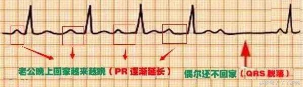 自己怎么看懂心电图（这样教你看心电图）(8)