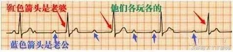 自己怎么看懂心电图（这样教你看心电图）(10)