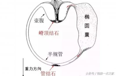 ​眩晕不要忽略耳石症，眩晕中的主力之一，手法复位显神通（二）