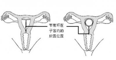 ​女人在做取环手术的过程是怎么样的, 这个取环过程会不会痛